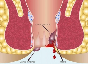 Trĩ nội chảy máu phải làm sao?